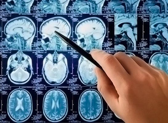 Brain Cancer Radiation Protection Brain Cancer Radiation Protection - airestech